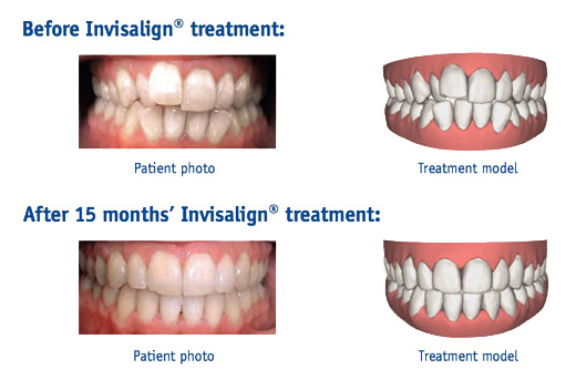 Invisalign Clear Braces in Stevenage - Stevenage Dental Studio