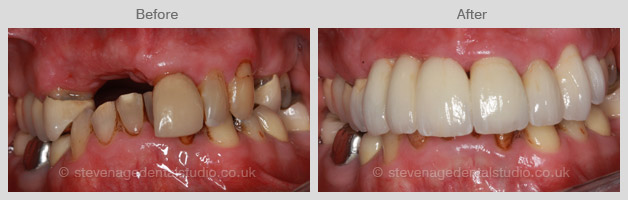 Dental Smiles Gallery Stevenage - Stevenage Dental Studio